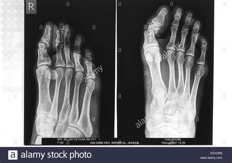 X ray of fractured right great toe before surgery , Bombay Mumbai Stock ...