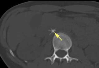 RiT radiology: Inferior Vena Cava (IVC) Filter: Indications