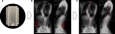 Traditional T1-S1 Measurement of the Spinal Length on X-ray Images Does Not Correlate With the ...