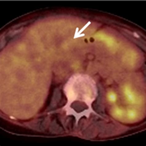 A 75-year-old woman with liver lesions. Contrast-enhanced CT ...