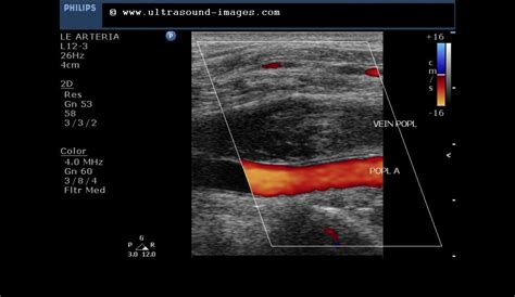 cochinblogs: Popliteal vein thrombosis- on arterial Doppler study