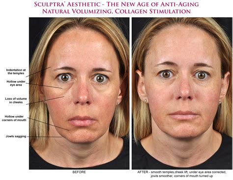 How Do Dermal Fillers Work In The Skin at Jessica Gaiter blog