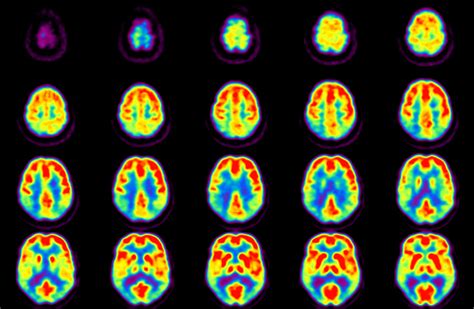 PET Imaging | Brain Aging & Cognitive Health Lab | University of Pittsburgh