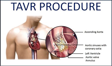 TAVI Surgery in Mumbai | Dr. Kamlesh Jain