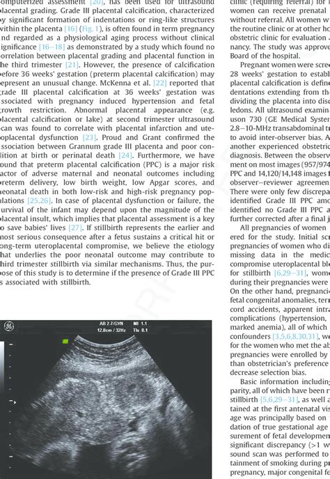 Grade III placental calcification according to the Grannum ...