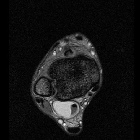 Flexor Hallucis Longus Mri