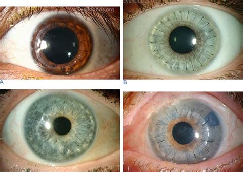 Cornea transplant types, success rate, vision after transplant, rejection, complications