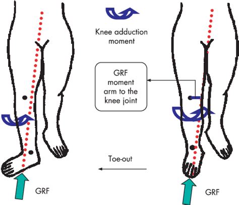 Out-toeing during walking shifts the ground reaction force (GRF) vector ...