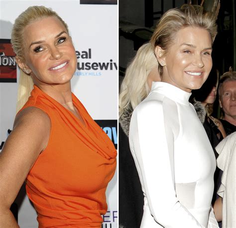 Celebrities Who Removed Their Breast Implants— Before-and-After Pics