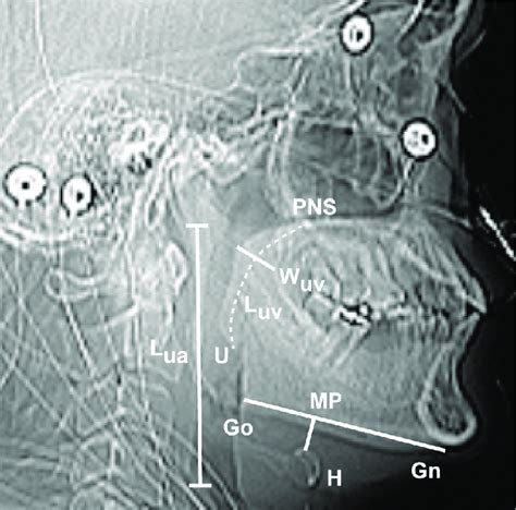 Linear measurements on a lateral scout image. Gn, gnathion (most... | Download Scientific Diagram