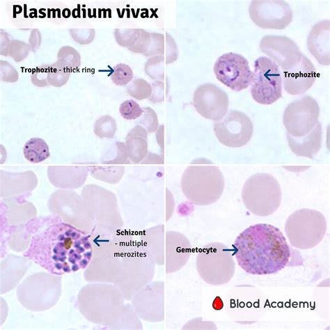 Plasmodium Vivax - Blood Academy