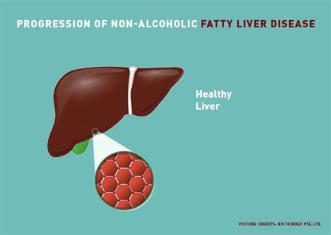 Exposing A Silent Killer: Liver Disease – Asian Scientist Magazine