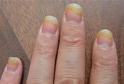 Nail Fungus Treatment