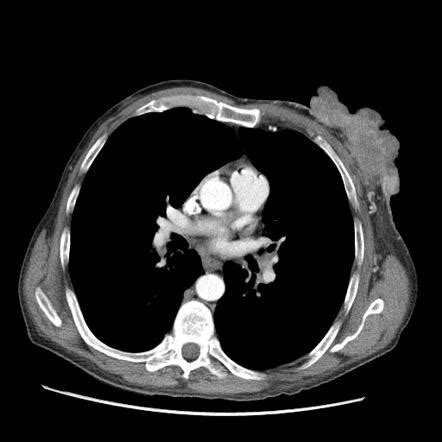 Male breast cancer | Radiology Reference Article | Radiopaedia.org