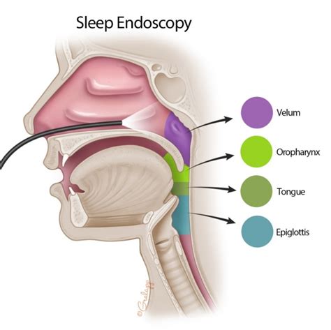 Stanford Sleep Surgery | Otolaryngology⁠ — Head & Neck Surgery | Stanford Medicine