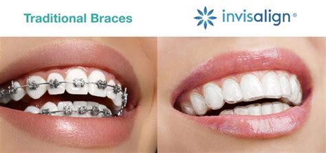 What Are Clear Braces? The Pros And Cons Of Invisible, 45% OFF