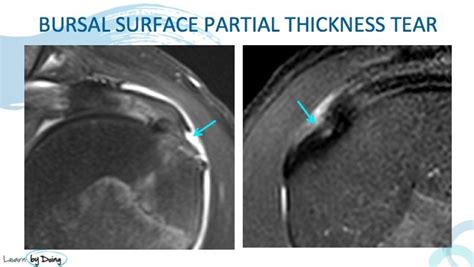 MRI Rotator Cuff Tendinosis Vs Tears - Radedasia