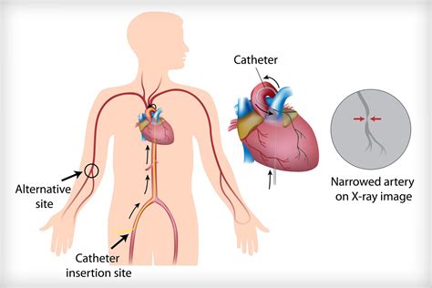 Cardiac Catheterization – Cardiovascular Disease Specialists of Pittsburgh