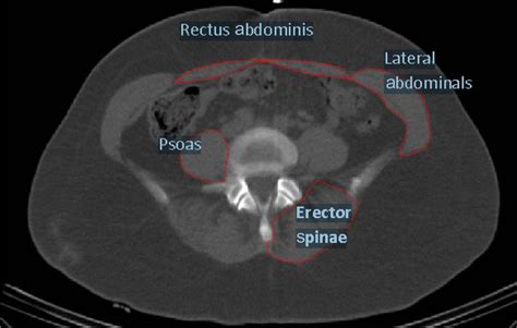 is an example of the CT tracing analysis for the trunk muscle... | Download Scientific Diagram