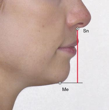Dimensión vertical oclusal, medida desde Subnasal a la proyección... | Download Scientific Diagram