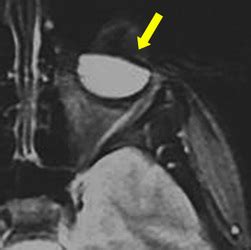 Susceptibility artifact - Questions and Answers in MRI