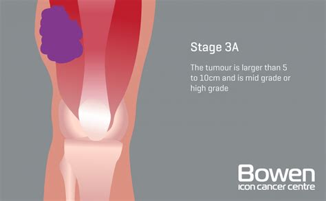 What is Soft Tissue Sarcoma? Soft Tissue Sarcoma Explained — Bowen Icon Cancer Centre