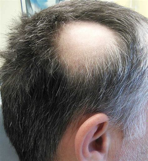 Scalp Micropigmentation for Bald Spots - Scalp Micro Portugal