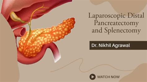 Technique of Laparoscopic Distal Pancreatectomy and Splenectomy | Dr ...