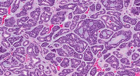 Carcinoma adenoide quístico | MyPathologyReport.ca