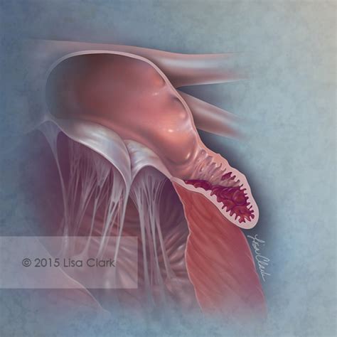 Left Atrial Appendage Thrombus – Artists' Blogs :: Medical Illustration ...