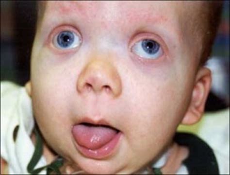 Beckwith Wiedemann Syndrome Pictures, Prognosis, Management