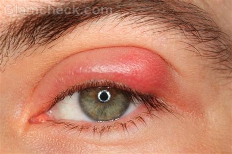 Types of Eye Infections: Symptoms, Causes & Treatments