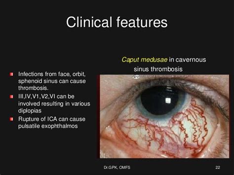 Cavernous Venous Sinus Thrombosis