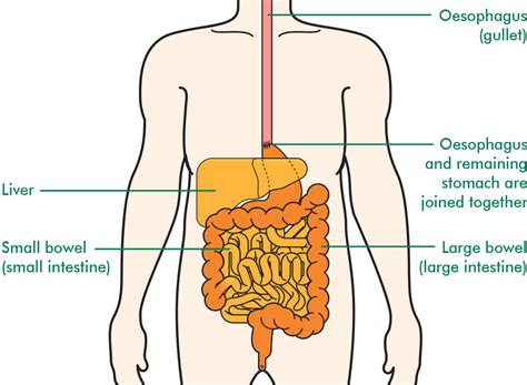 Surgery for oesophageal cancer - Information and support - Macmillan Cancer Support