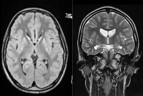 Huntington's Disease - Causes, Symptoms, Diagnosis and Treatment