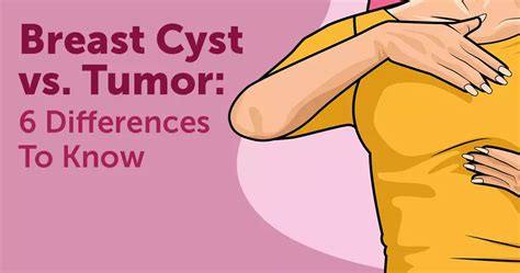 Breast Cyst vs. Tumor: 6 Differences To Know | MyBCTeam