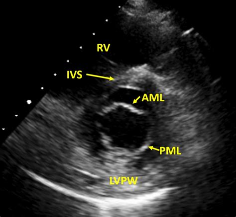 Normal Mitral Valve