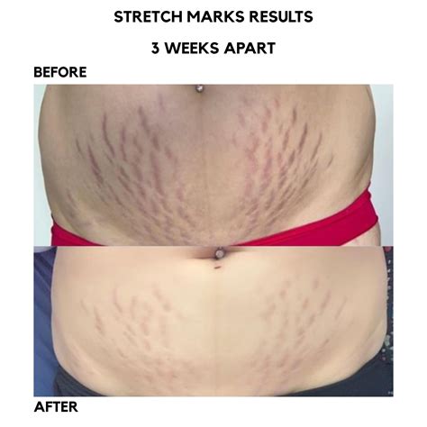 Stretch Mark Results In 3 Weeks | Before & After | Bangn Body