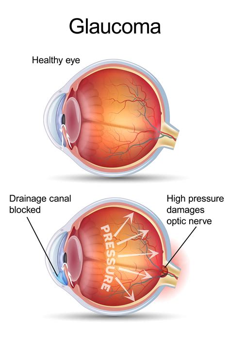 Merrillville, IN Selective Laser Trabeculoplasty - SLT for Glaucoma ...