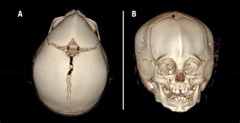 Craniosynostosis: Causes, Symptoms, Diagnosis And Treatment, 52% OFF