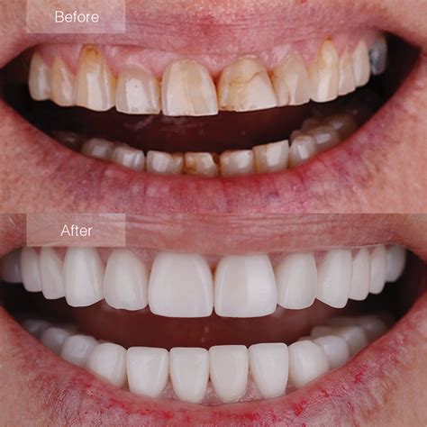 Porcelain Veneers Before and After - The Dental Room