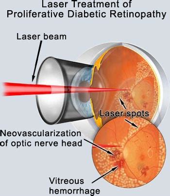 North Hills Eye Associates / Karlik Ophthalmology - Diabetic Retinopathy