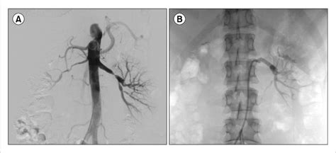 Conventional angiogram of renal artery demonstrates bilateral renal... | Download Scientific Diagram