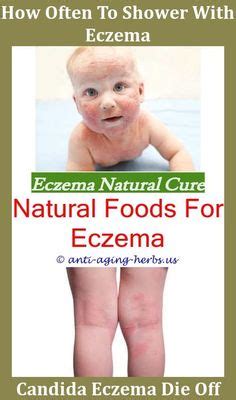 Eczema Diet