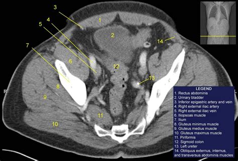 Image result for iliacus muscle ct scan