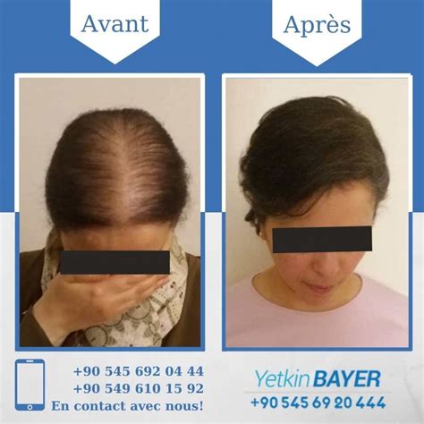 Greffe de Cheveux Femme Turquie | Dr. Yetkin Bayer Clinics