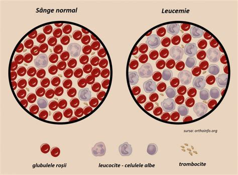 Leucemia: cauzele, simptomele și tratamentul ei | DCMedical.ro