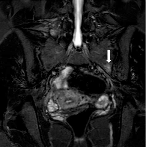 Sacroiliitis – Findings on Conventional Radiography, CT and MRI studies | Semantic Scholar