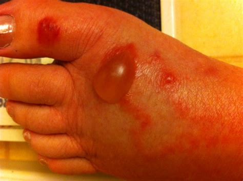 Bullous Pemphigoid | Blistering Skin Disease | HubPages