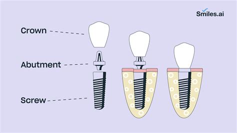 The Dental Implant Procedure Explained Step By Step | Free Hot Nude Porn Pic Gallery